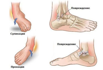Durere la nivelul piciorului de lângă degete, cauze comune ale simptomelor