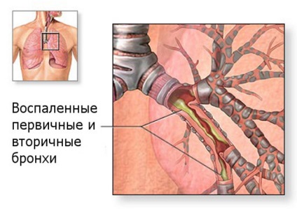 Bronșita acută și cronică, semne și simptome, tratament, medicină populară