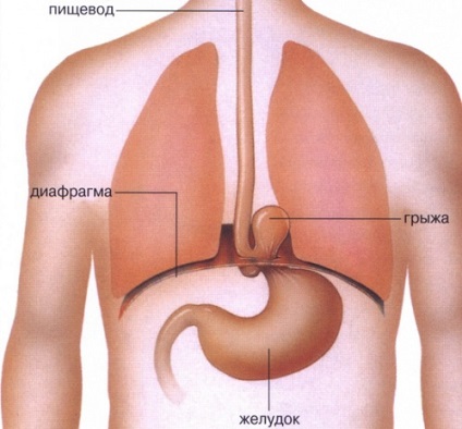 A reflux-nyelőcsőgyulladás kezelése és a kezelés alapvető megközelítései