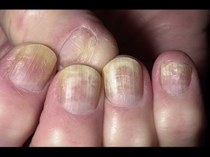 Sarcina între degete (roșeață, peeling), cauze și tratament