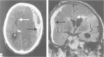 Sindromul de dislocare