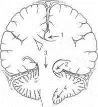 Sindromul de dislocare