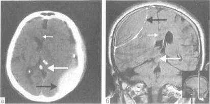 Sindromul de dislocare