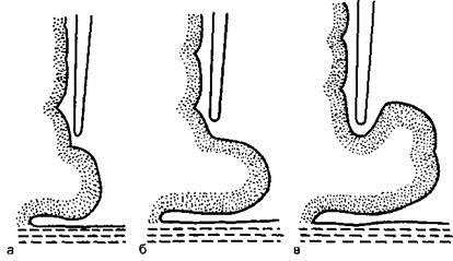 Sindromul de dislocare