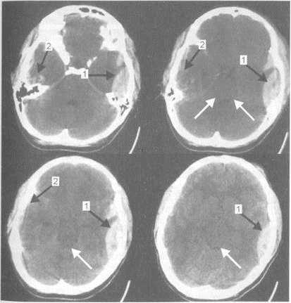 Sindromul de dislocare