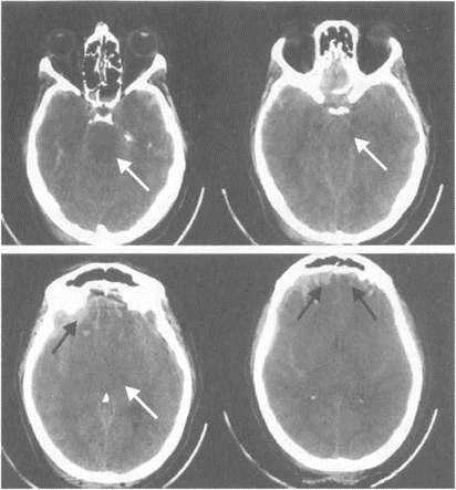 Sindromul de dislocare