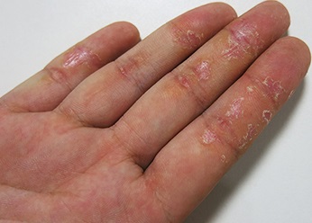 Eczema la om - fotografii, cauze și tratamentul eczemelor la adulți