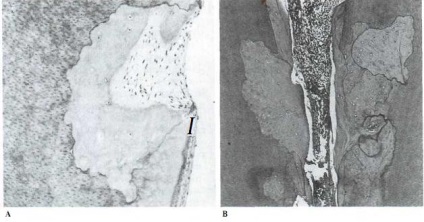 Endodontic szempontjai gyökérreszorpció - gyökérkezelés, technikák és elvek endodontikus kezelés