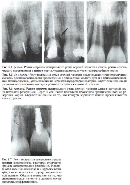 Aspecte endodontice ale resorbției radiculare - endodonție, tehnici și principii de tratament endodontic