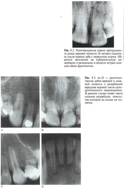 Endodontic szempontjai gyökérreszorpció - gyökérkezelés, technikák és elvek endodontikus kezelés