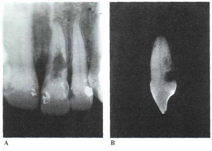 Endodontic szempontjai gyökérreszorpció - gyökérkezelés, technikák és elvek endodontikus kezelés