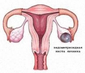 Chist ovarian endometrioid