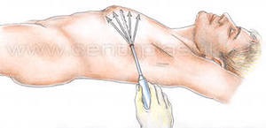 Tratamentul endoscopic al ginecomastiei