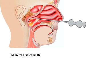 Sinuzita tratament purulent al perioadei acute a bolii