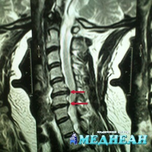 Hernia coloanei vertebrale cervicale - simptome și tratament, Centrul Medical Mednan