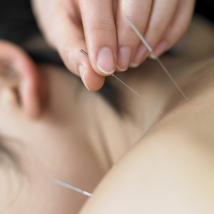 Acupunctura cu osteocondroza a compartimentului de col uterin