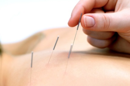 Acupunctura pentru osteocondroza regiunii cervicale