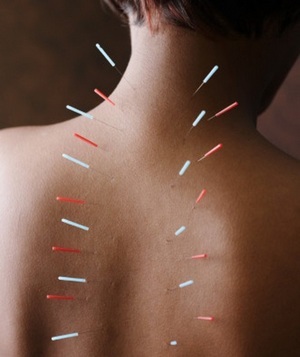 Acupunctura pentru osteocondroză