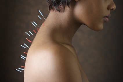 Acupunctura pentru osteocondroză