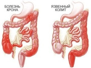 Inflamația infectantă a intestinului