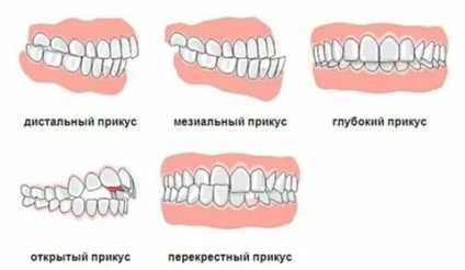 Corectarea ocluziei - lumea stomatologiei