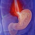 Pirozis cu simptome de pancreatită, tratament