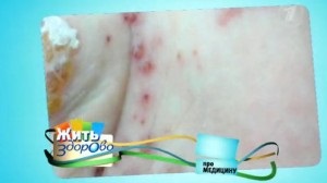 Cum să scapi de psoriazis, transferul este sănătos cu arhiva video online a bebelușului