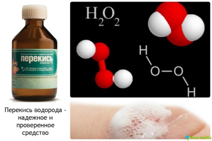 Cum se utilizează medicamentele în tromboflebită dacă este posibil să se utilizeze peroxid de hidrogen