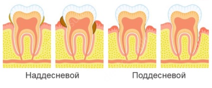 Як прибрати зубний камінь, навіщо це робити, огляд методів