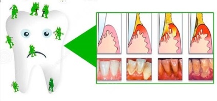 Cum să eliminați tartrul, de ce o facem, o revizuire a metodelor