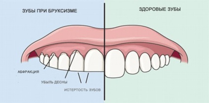 Pungi cu bruxism în timpul zilei și pentru tipuri de somn, design, alegere, preț