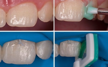 Caries de rădăcină a unui dinte pentru a trata sau pentru a șterge case sau la stomatolog