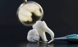 Fogszuvasodás - okai, tünetei, megelőzése és kezelése - Dr. fogat