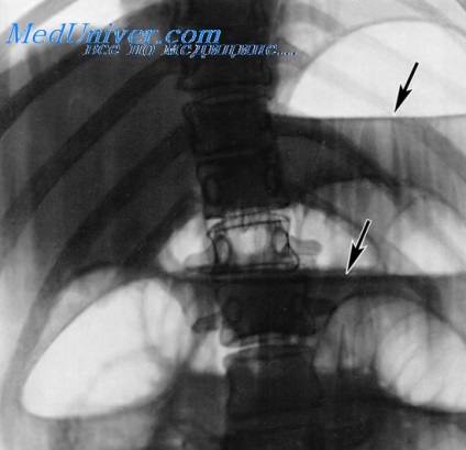 Clinica de obstrucție intestinală