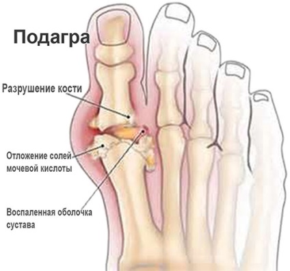 Comprese pentru analgezice pentru eliminarea tumorilor; instrucție