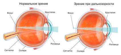 Corectarea vederii în hiperopie - centrul operației oculare