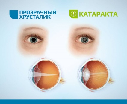 Tratamentul cataractei în Odessa