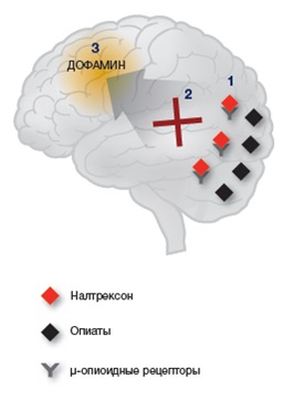 Tratamentul cu Vivitrol