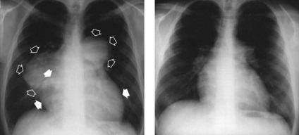 Hipertensiune pulmonară 1 grad, ce este - toate întrebările și răspunsurile despre hipertensiunea pulmonară, pe