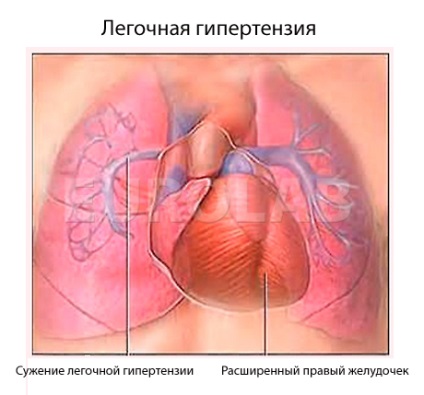 Hipertensiune pulmonară 1 grad, ce este - toate întrebările și răspunsurile despre hipertensiunea pulmonară, pe