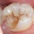 Calendarul lunar al tratamentului stomatologic, zile favorabile pentru extracția dinților