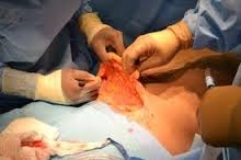 Metode de tratament al ginecomastiei la bărbați endoscopici