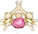 Hernia intervertebrală a departamentului de col uterin, p.