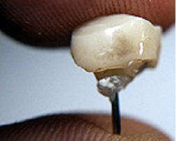 Mert cu contraindicații pentru diagnosticul coroanelor dentare