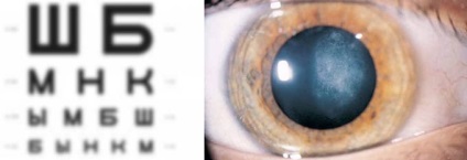 Etapa cataractei inițiale, simptome care provoacă dezvoltarea