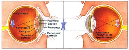 Etapa cataractei inițiale, simptome care provoacă dezvoltarea