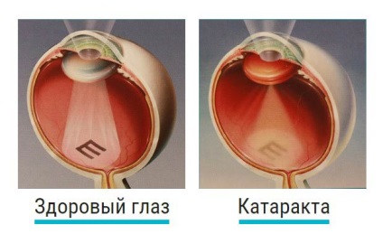 Etapa cataractei inițiale, simptome care provoacă dezvoltarea