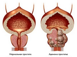 Metodele populare de tratare a prostatitei și a adenomului de prostată sunt cele mai comune rețete