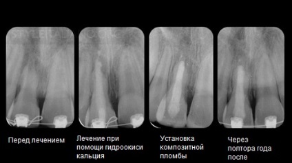 Resorbție inflamatorie externă a rădăcinii dintelui