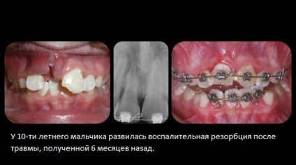 Külső gyulladásos gyökérreszorpció fogak